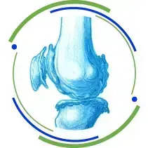 tratamento para artrose no joelho em Brasília: ilustração de artrose (desgaste do joelho)